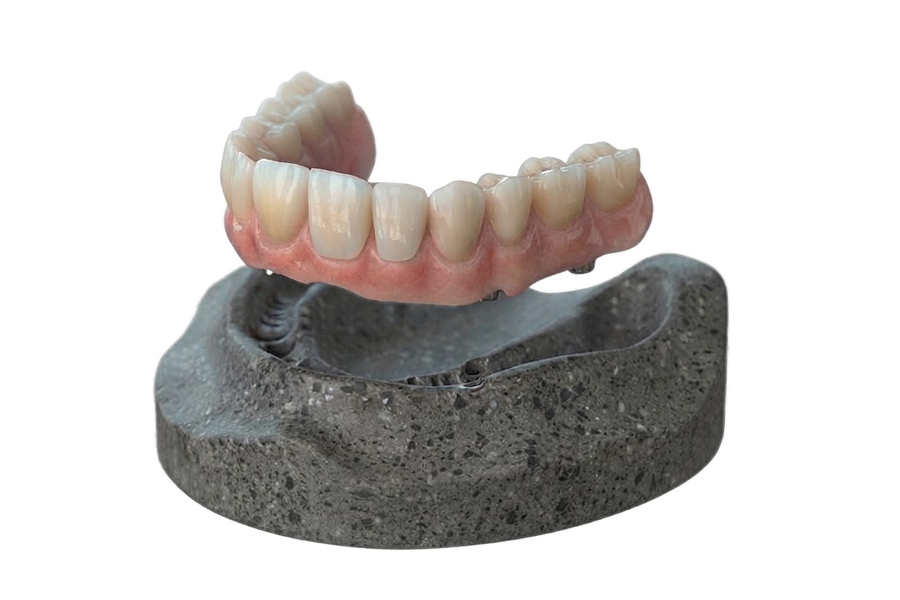 Faccette Dentali e Intarsi - Laboratorio Odontotecnico Bertolini